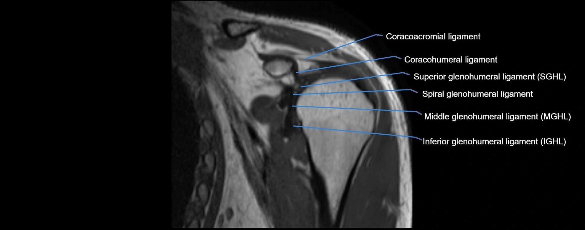 shoulder ligments coronal  cross sectional anatomy 3T MRI AI enhanced radiology image -img-00001-00014.webp